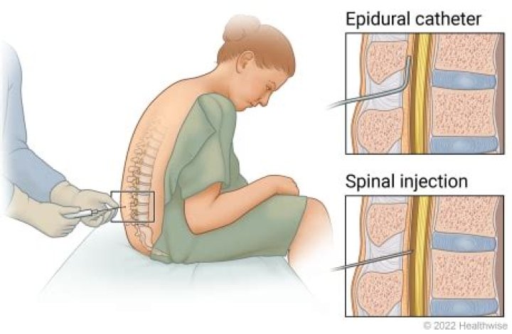 Are epidurals common in Germany?