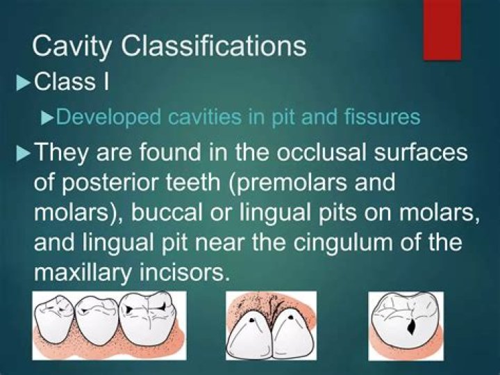 Are pits and fissures cavities?