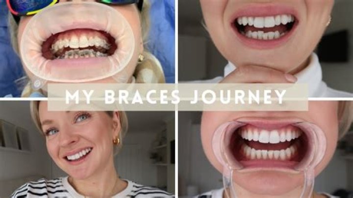 Can a 50 year old wear braces?