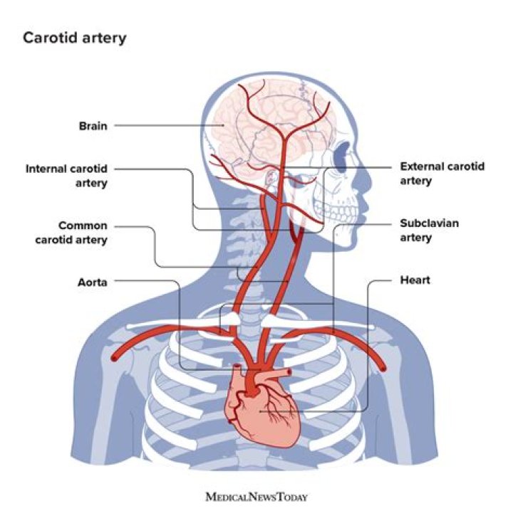 Can a carotid artery affect your ear?
