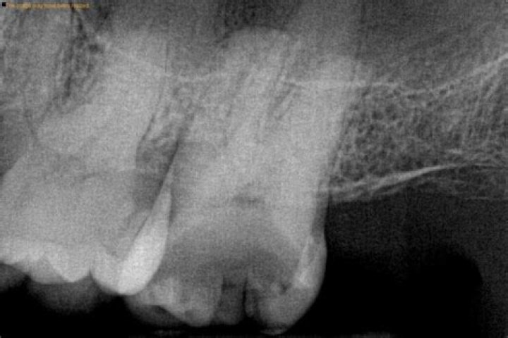 Can a dental x-ray show nerve damage?