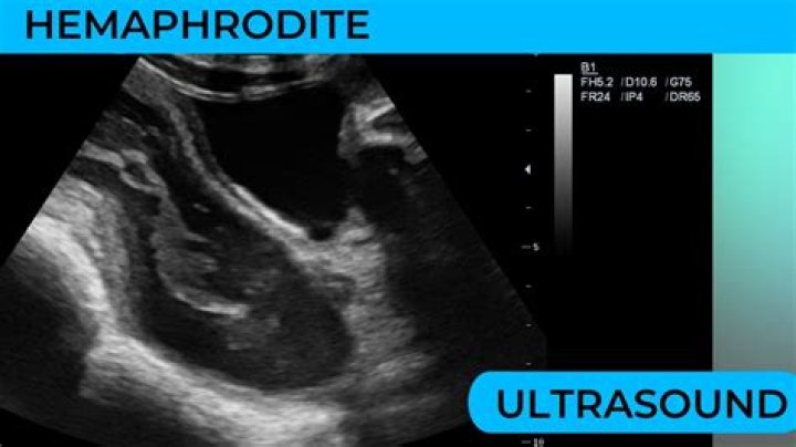 Can a hermaphrodite human have babies?