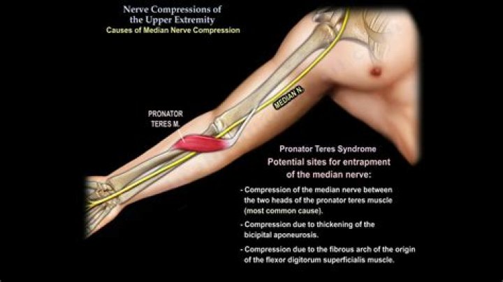 Can a pinched nerve in neck cause tennis elbow?