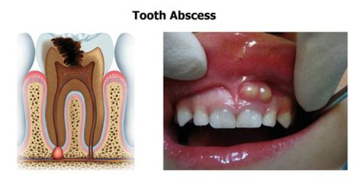 Can a tooth abscess make your face numb?