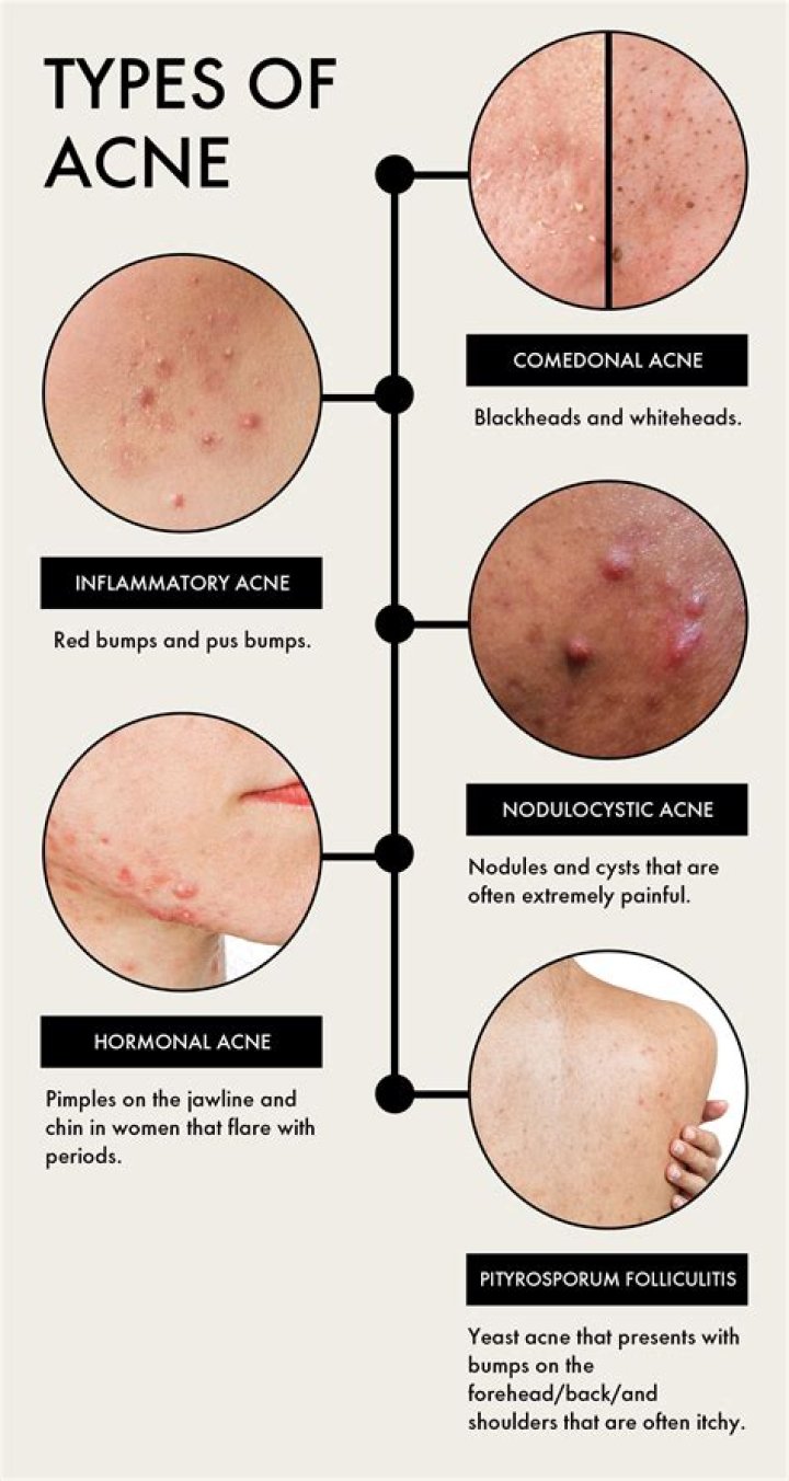 Can allergy look like acne?
