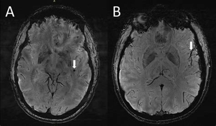 Can an MRI detect migraine?