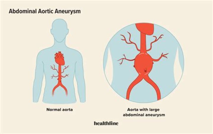 Can aneurysm heal itself?