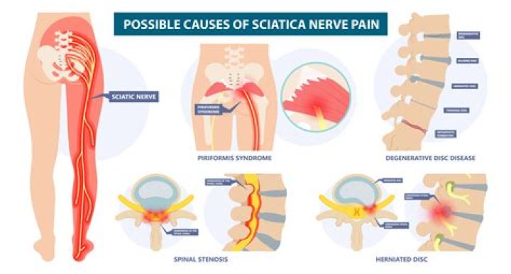 Can bowels put pressure on sciatic nerve?