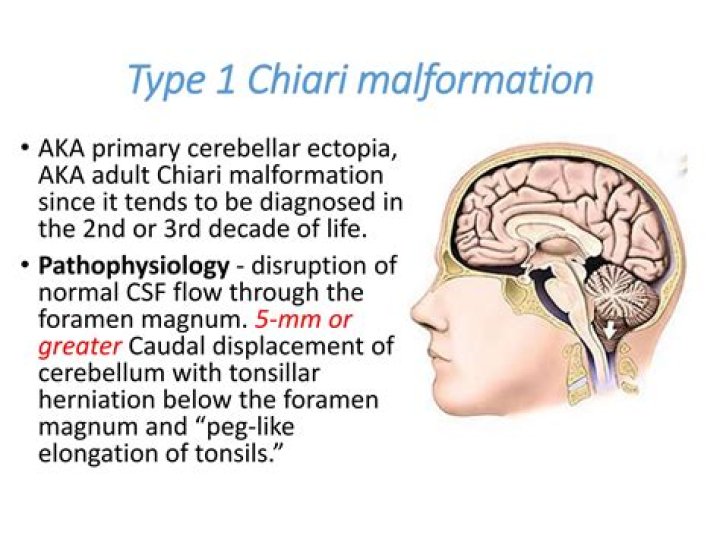 Can Chiari malformation cause liver problems?