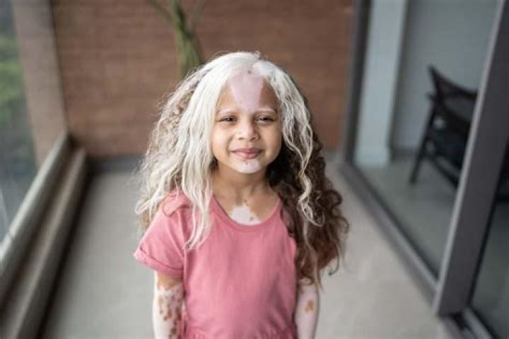 Can childhood vitiligo go away?