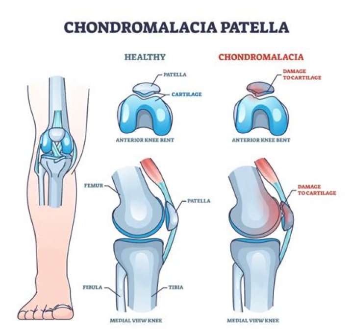 Can chondromalacia patella be caused by trauma?