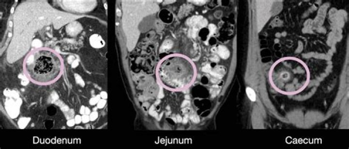 Can CT scan contrast cause a rash?