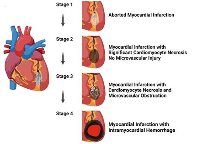 Can damage to the heart muscle be reversed?
