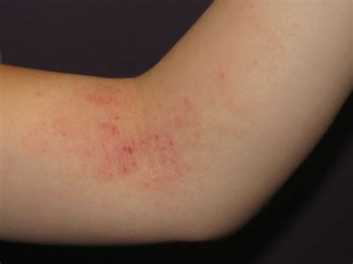 Can dry air cause rashes?