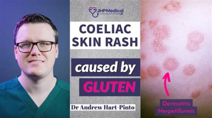 Can gluten cause chest rash?