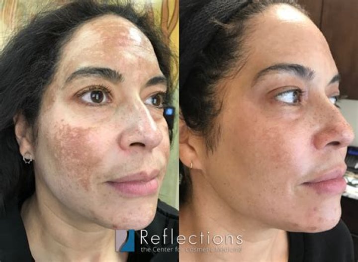 Can glycolic acid damage your skin?