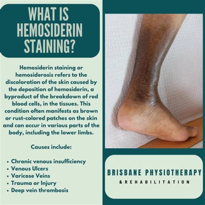 Can hemosiderin be reversed?