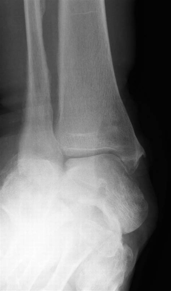 Can hindfoot valgus be fixed?