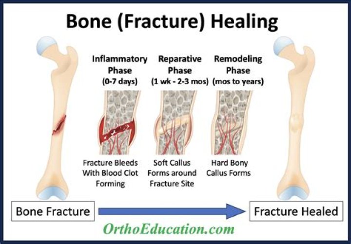 Can knee fracture heal on their own?
