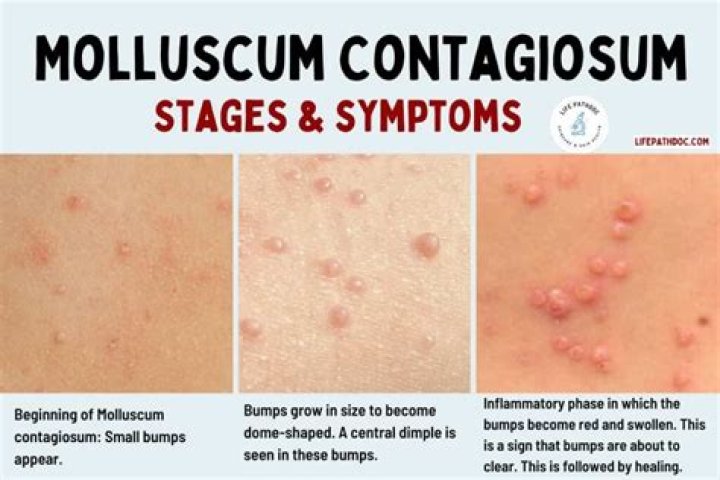 Can molluscum contagiosum make you feel sick?