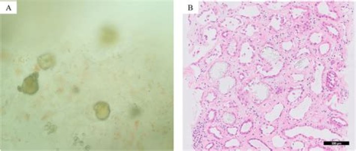 Can oxalate nephropathy be reversed?