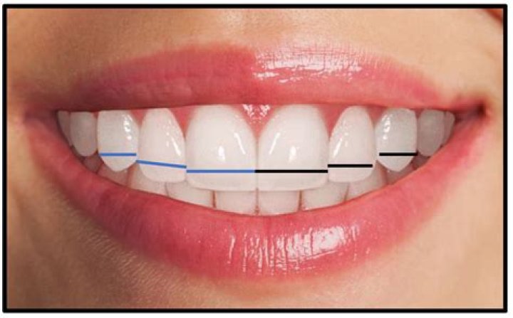 Can short teeth be lengthened?