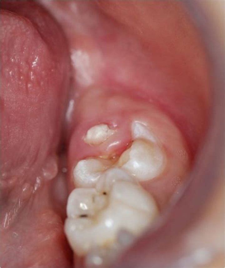 Can teething molars cause fever?