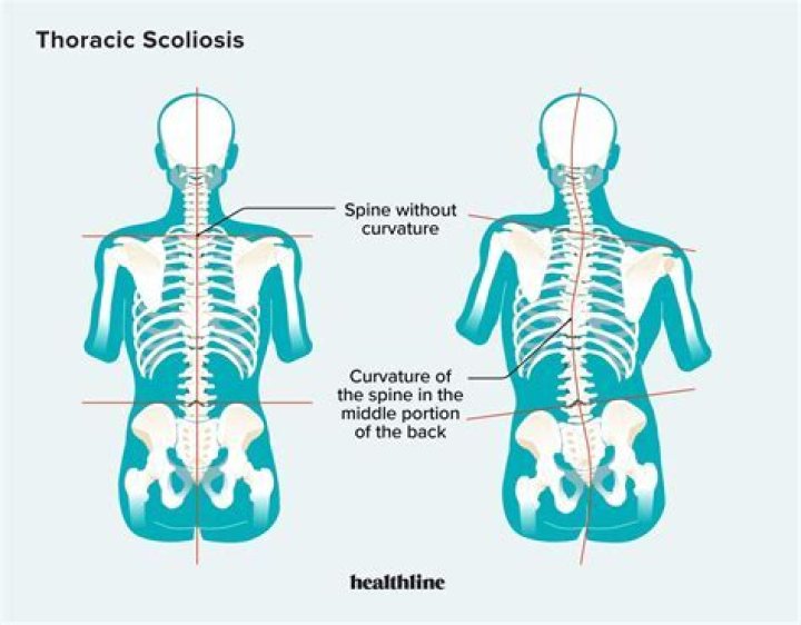 Can thoracic scoliosis be corrected?