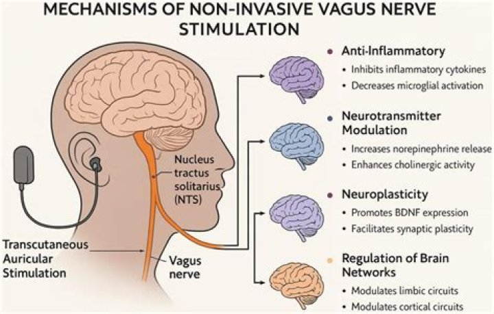 Can vagus nerve cause LPR?