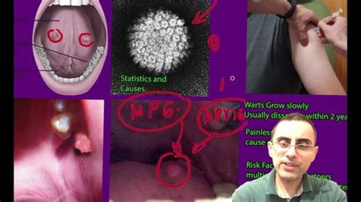 Can warts grow on your gums?