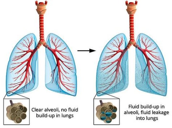 Can you get fluid in your lungs by drinking water?