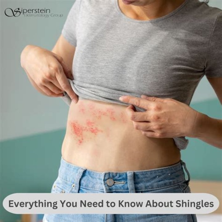 Can you get shingles from emotional stress?