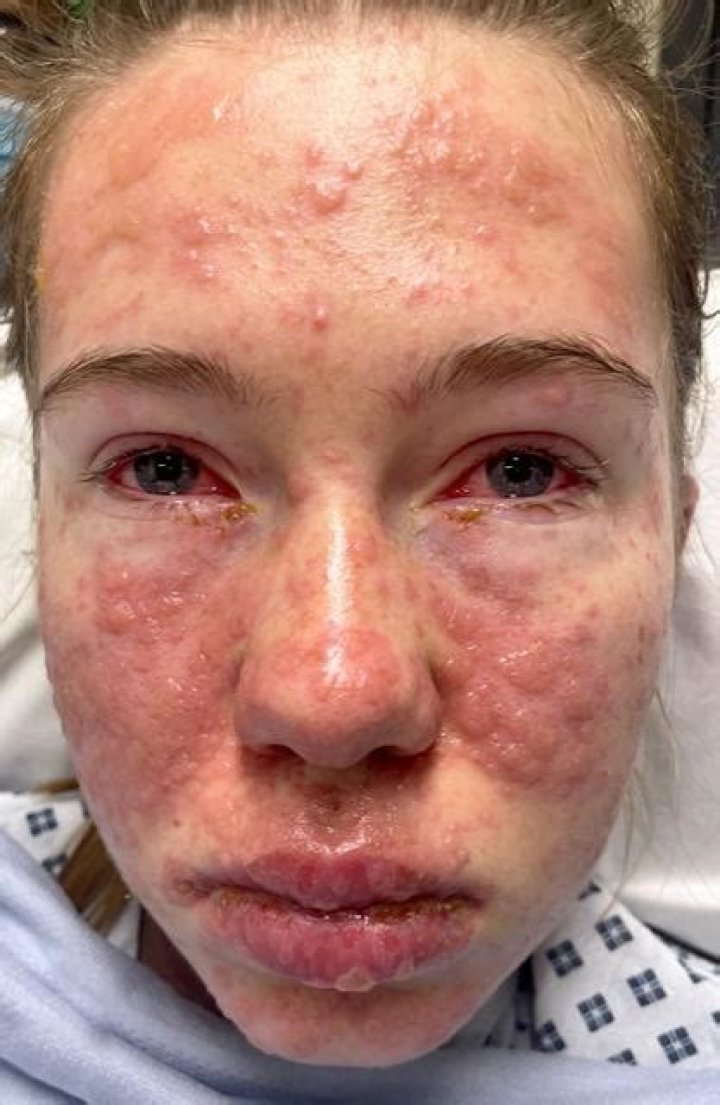 Can you have a mild case of Stevens-Johnson syndrome?