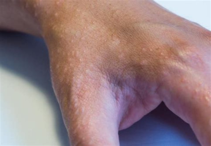 Can you have eczema on one hand?