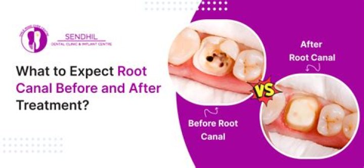 Can you have teeth whitened after root canal?