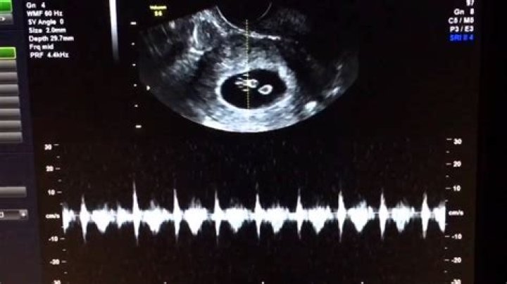Can you hear a heartbeat on a Doppler at 7 weeks?