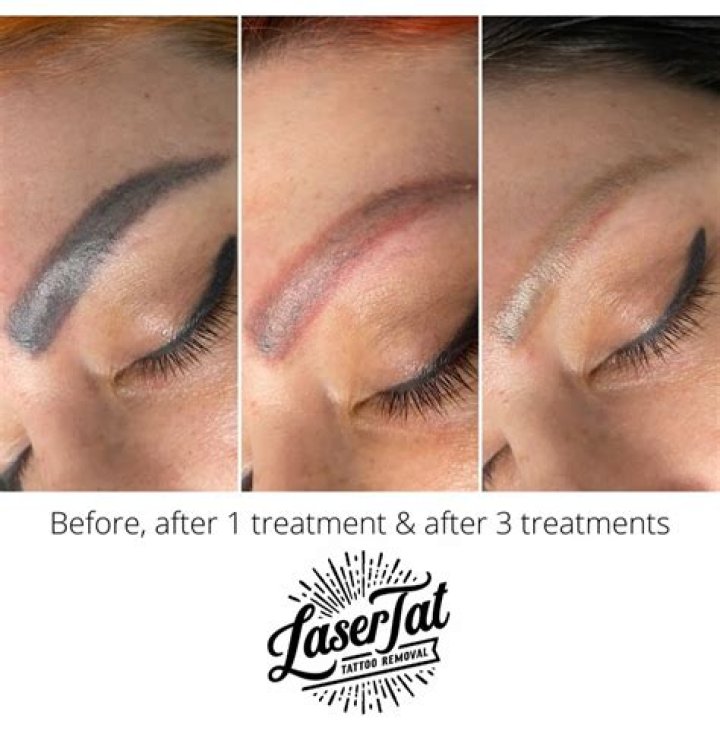 Can you laser remove eyebrow hair?