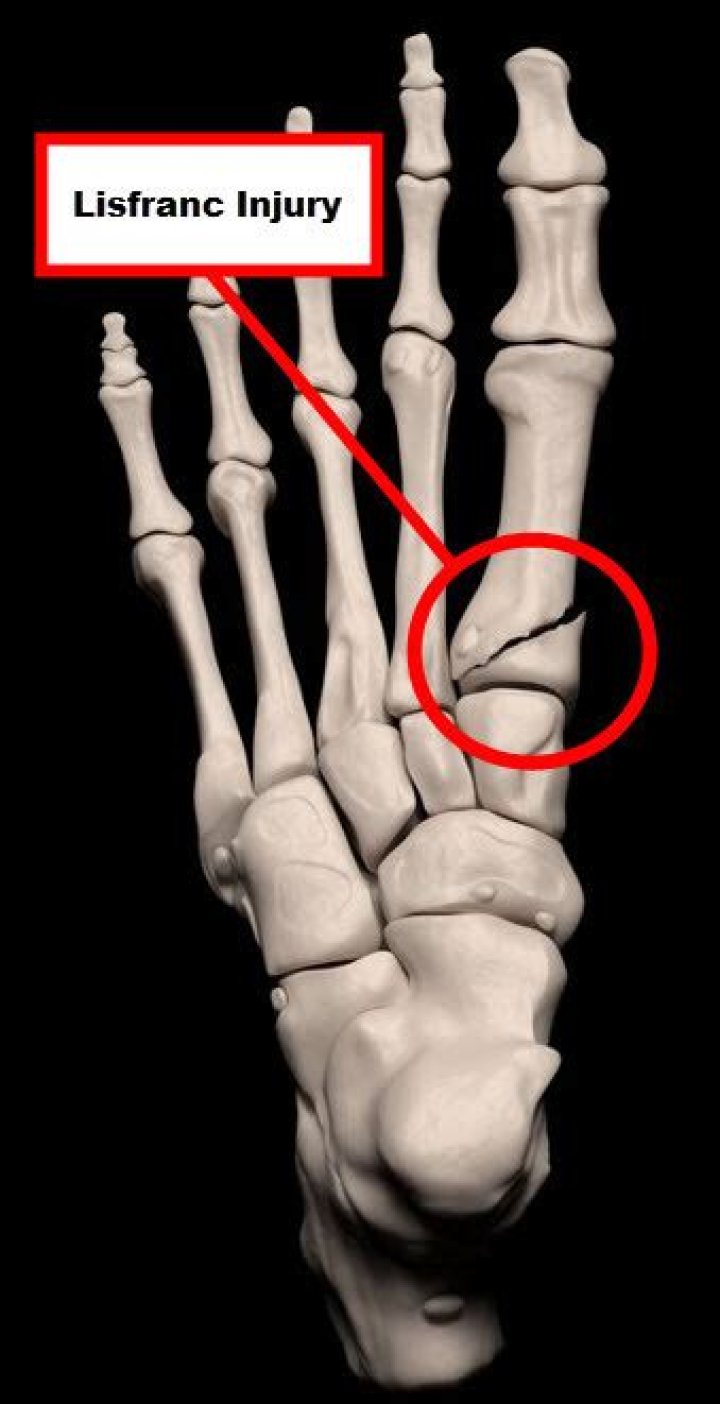Can you play football with a Lisfranc injury?