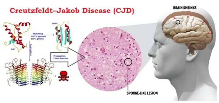 Can you recover from Creutzfeldt-Jakob disease?