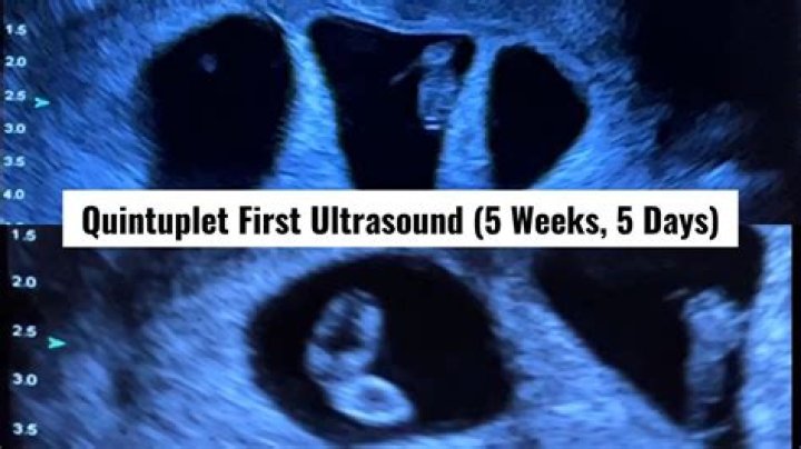 Can you see anything on an ultrasound at 5 weeks?