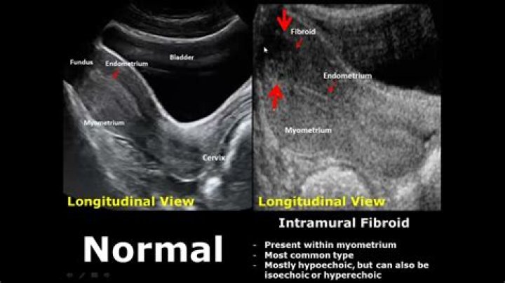 Can you see cervix on MRI?