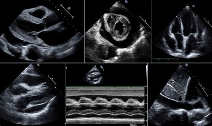 Can you see pericardial effusion on Echo?