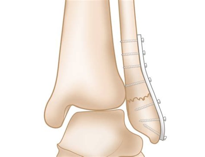 Can you walk on a lateral malleolus fracture?