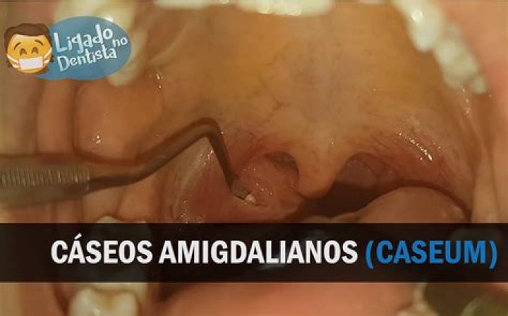 Como expulsar Caseum da garganta?