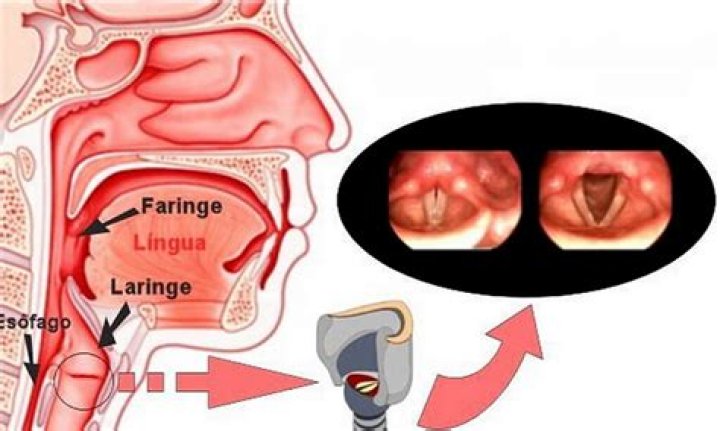 Como identificar a laringite?