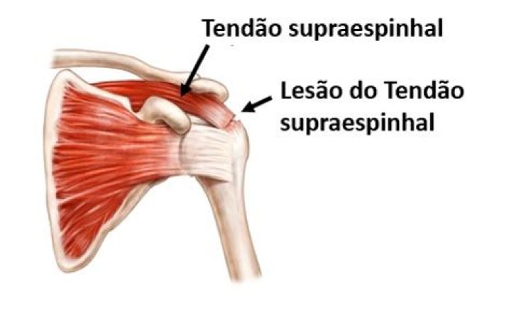 Como tratar ruptura do tendao supraespinhal?