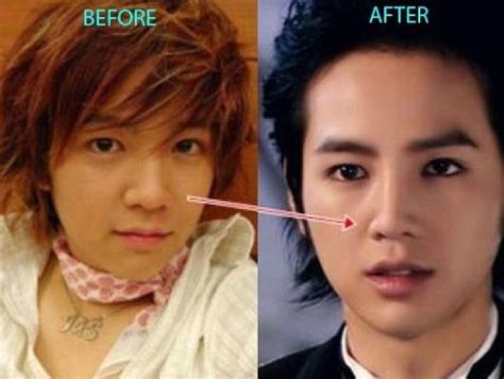 Did Kyuhyun do plastic surgery?