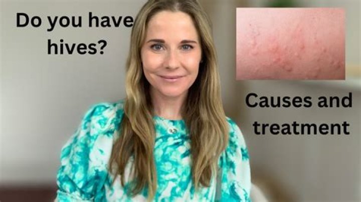 Do hives make your stomach hurt?