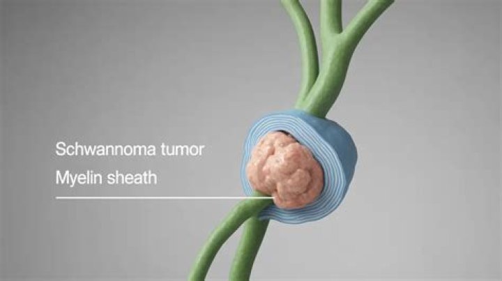 Do schwannomas run in families?