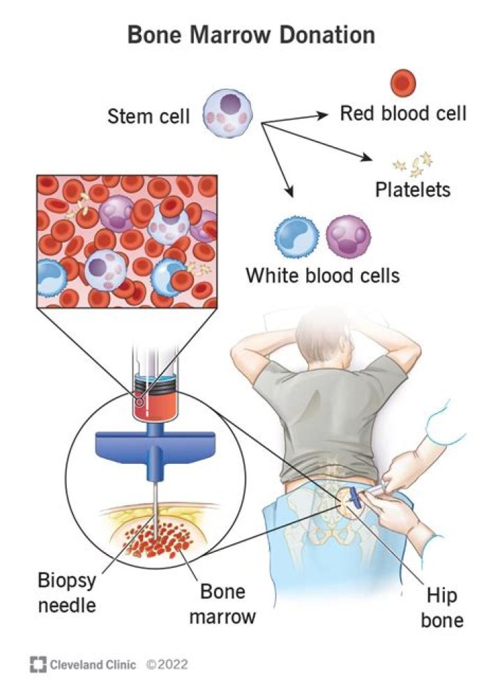Do transplant patients take on characteristics of the donor?